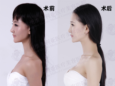 隆胸前后對(duì)比圖 隆胸前后對(duì)比圖